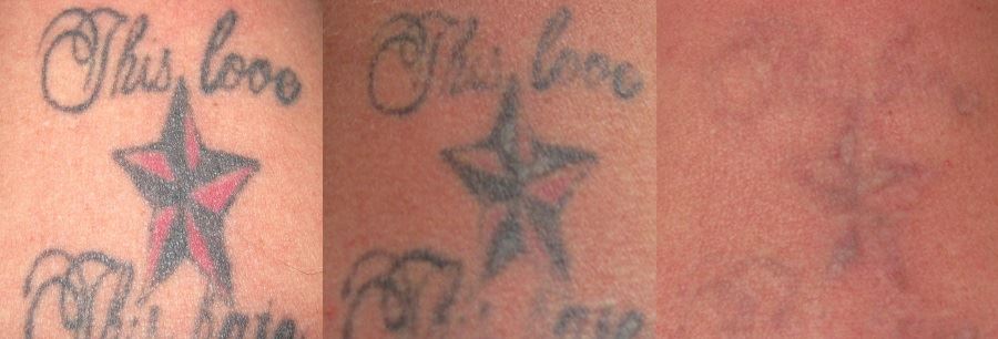 Tattoo Removal before after 2 Tattoo Removal before after 2