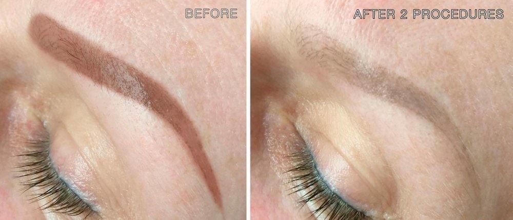Eyebrows tattoo removal Eyebrows tattoo removal