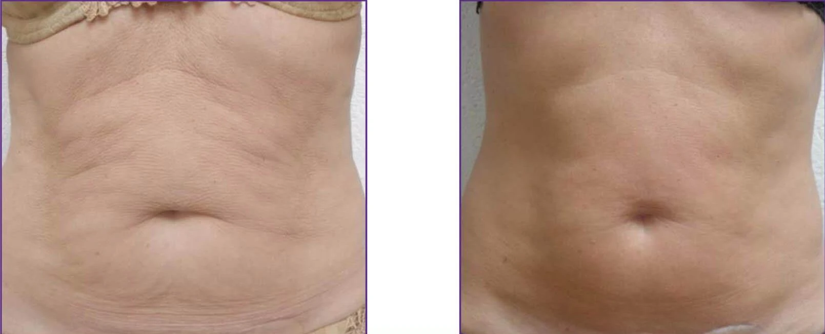microneedle-fractional-rf before after body 1