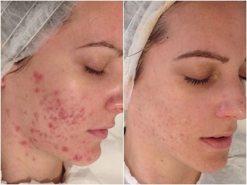 microneedle-fractional-rf before after face2