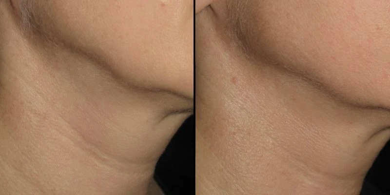 microneedle-fractional-rf before after neck