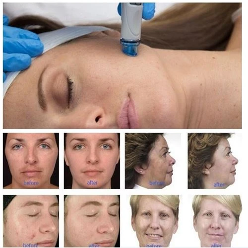 CE Approved  Small Bubble Machine For Multyfunctional Skincare